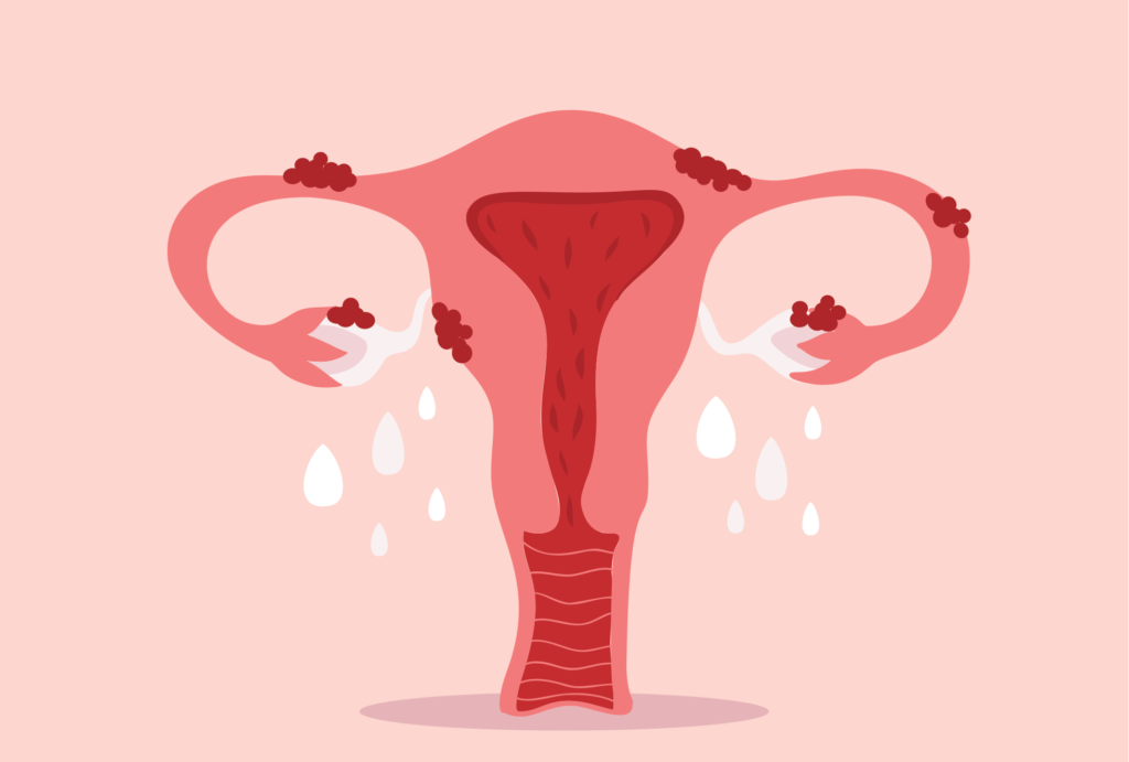 Facts About Endometriosis: Myths And Misconceptions