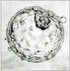 Importance of blastocyst in IVF
